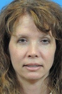 Rhinoplasty Before and After Pictures Indianapolis, IN