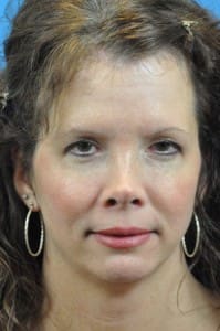 Rhinoplasty Before and After Pictures Indianapolis, IN