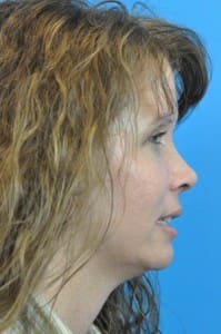 Rhinoplasty Before and After Pictures Indianapolis, IN