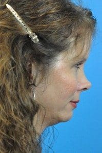 Rhinoplasty Before and After Pictures Indianapolis, IN