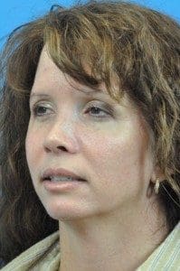 Rhinoplasty Before and After Pictures Indianapolis, IN