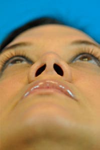 Rhinoplasty Before and After Pictures Indianapolis, IN