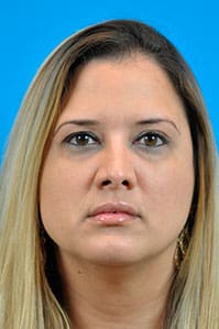 Rhinoplasty Before and After Pictures Indianapolis, IN