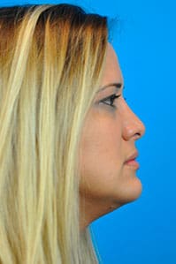 Rhinoplasty Before and After Pictures Indianapolis, IN