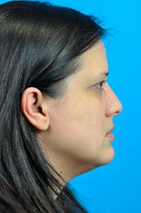 Rhinoplasty Before and After Pictures Indianapolis, IN