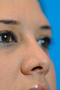 Rhinoplasty Before and After Pictures Indianapolis, IN