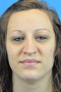 Rhinoplasty Before and After Pictures Indianapolis, IN