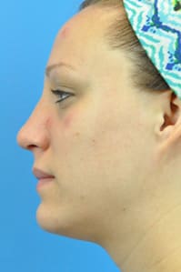 Rhinoplasty Before and After Pictures Indianapolis, IN