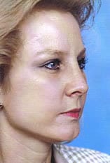 Rhinoplasty Before and After Pictures Indianapolis, IN
