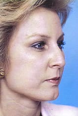 Rhinoplasty Before and After Pictures Indianapolis, IN