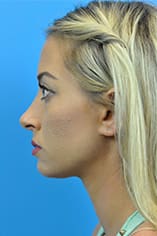 Rhinoplasty Before and After Pictures Indianapolis, IN