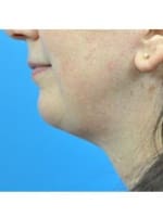 Chin Implant Before and After Pictures Indianapolis, IN