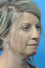 Rhinoplasty Before and After Pictures Indianapolis, IN