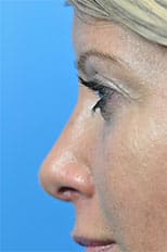 Rhinoplasty Before and After Pictures Indianapolis, IN