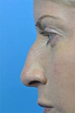 Rhinoplasty Before and After Pictures Indianapolis, IN