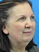 Chin Implant Before and After Pictures Indianapolis, IN