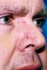 Skin Cancer Reconstruction Before and After Pictures Indianapolis, IN