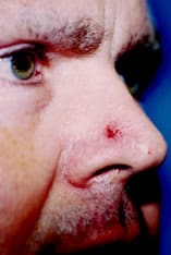 Skin Cancer Reconstruction Before and After Pictures Indianapolis, IN