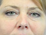 Skin Cancer Reconstruction Before and After Pictures Indianapolis, IN