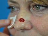 Skin Cancer Reconstruction Before and After Pictures Indianapolis, IN