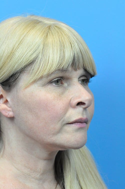 Facelift Before and After Pictures Indianapolis, IN