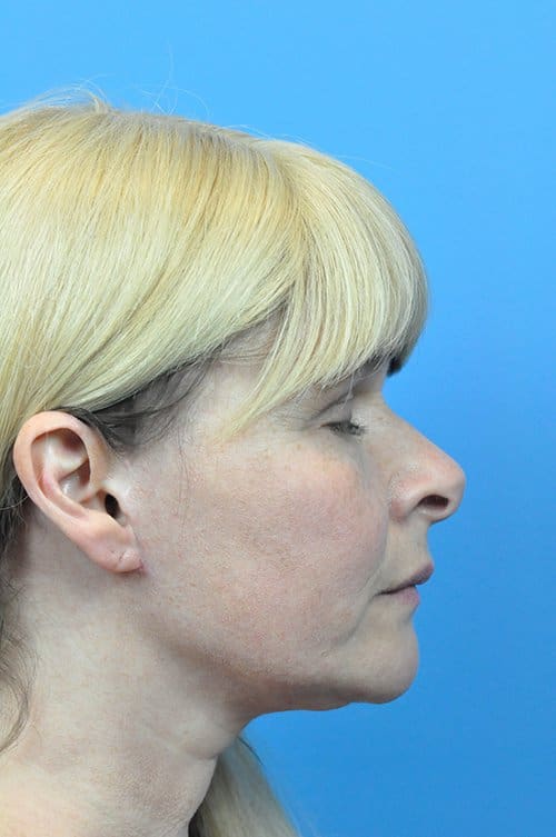 Facelift Before and After Pictures Indianapolis, IN
