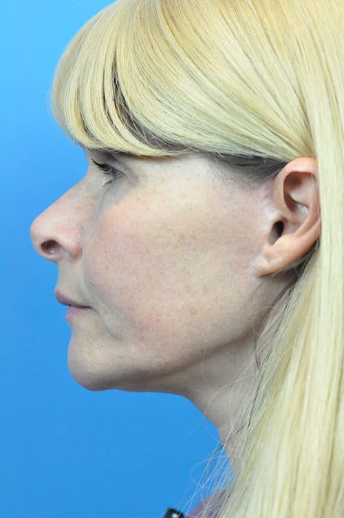 Facelift Before and After Pictures Indianapolis, IN