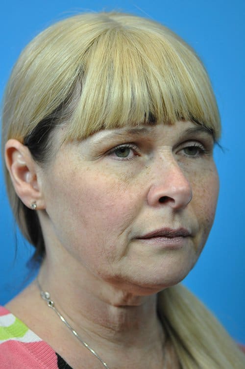 Facelift Before and After Pictures Indianapolis, IN