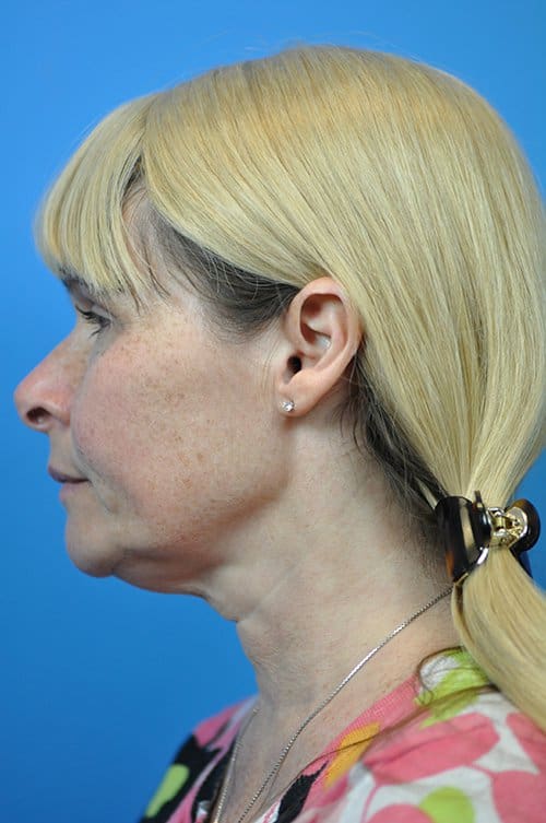 Facelift Before and After Pictures Indianapolis, IN