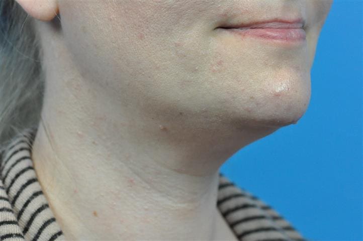 Submentoplasty Before and After Pictures Indianapolis, IN