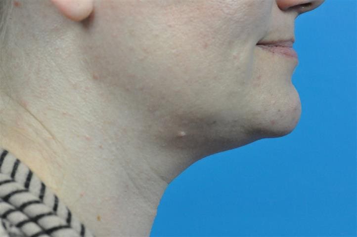 Submentoplasty Before and After Pictures Indianapolis, IN