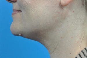 Submentoplasty Before and After Pictures Indianapolis, IN