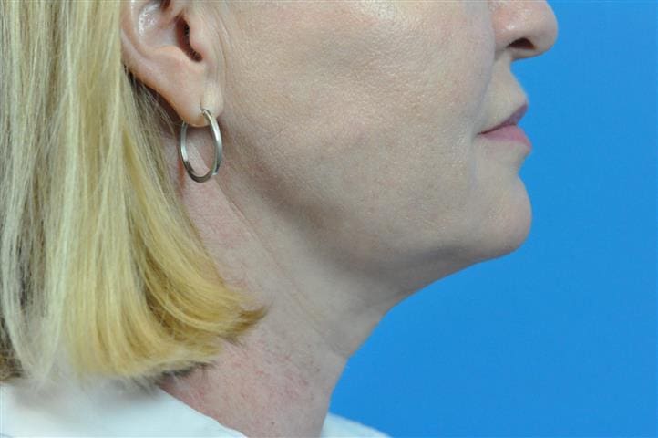 FaceTite Before and After Pictures Indianapolis, IN