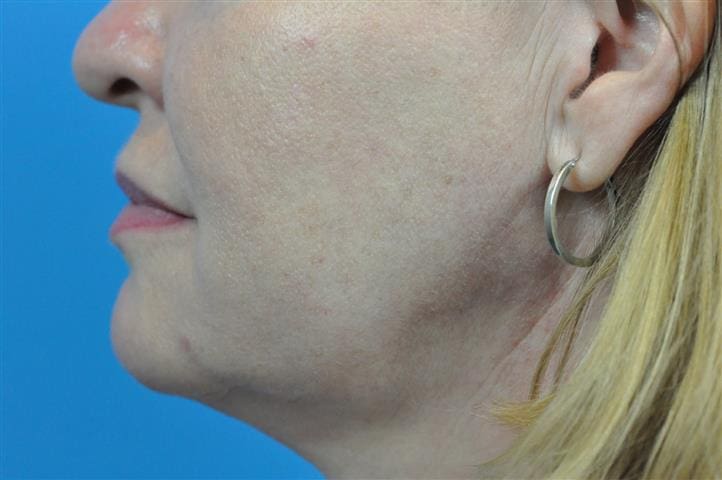 FaceTite Before and After Pictures Indianapolis, IN