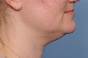 Submentoplasty Before and After Pictures Indianapolis, IN