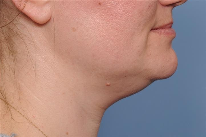 Submentoplasty Before and After Pictures Indianapolis, IN