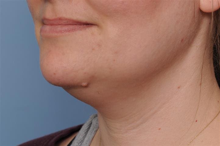 Submentoplasty Before and After Pictures Indianapolis, IN