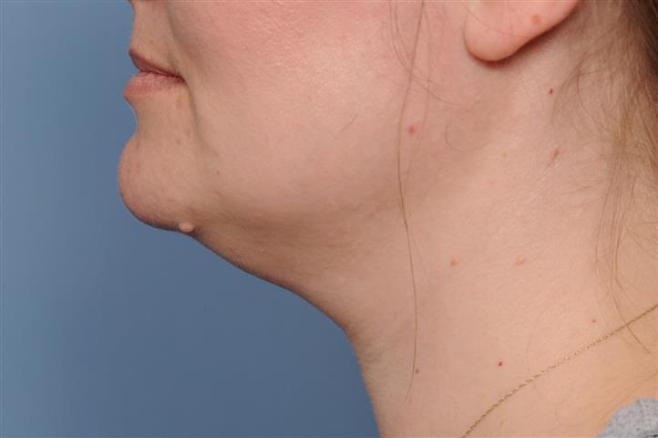 Submentoplasty Before and After Pictures Indianapolis, IN
