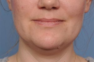 Submentoplasty Before and After Pictures Indianapolis, IN