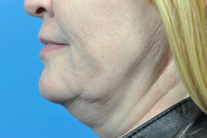 FaceTite Before and After Pictures Indianapolis, IN