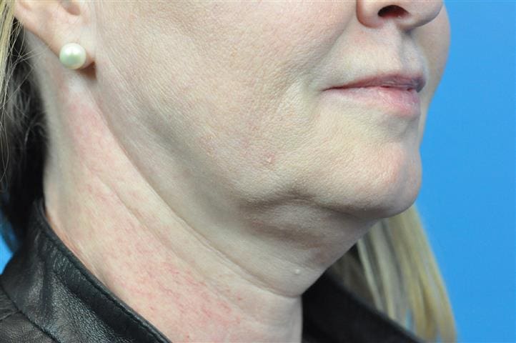 FaceTite Before and After Pictures Indianapolis, IN