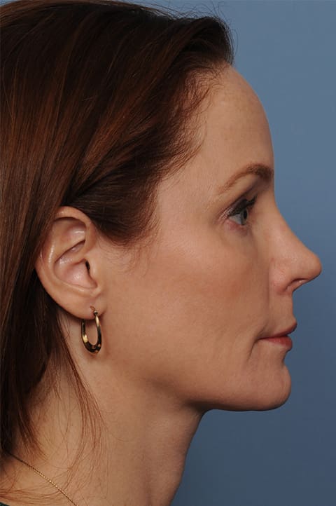 FaceTite Before and After Pictures Indianapolis, IN