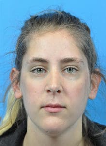 Rhinoplasty Before and After Pictures Indianapolis, IN