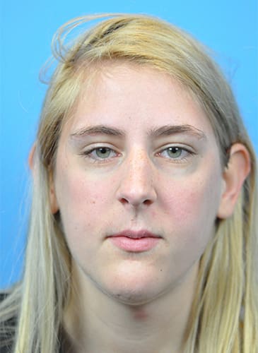 Rhinoplasty Before and After Pictures Indianapolis, IN