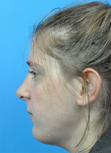 Rhinoplasty Before and After Pictures Indianapolis, IN