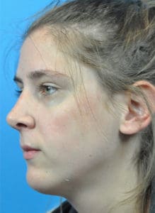 Rhinoplasty Before and After Pictures Indianapolis, IN