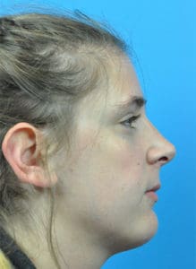 Rhinoplasty Before and After Pictures Indianapolis, IN