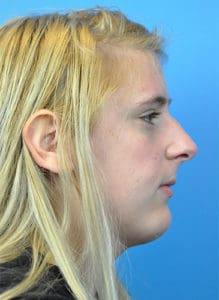 Rhinoplasty Before and After Pictures Indianapolis, IN