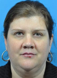 Rhinoplasty Before and After Pictures Indianapolis, IN
