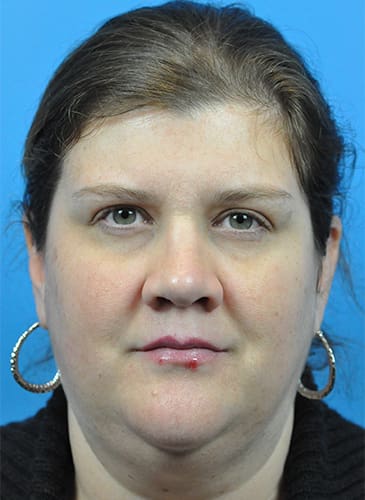 Rhinoplasty Before and After Pictures Indianapolis, IN